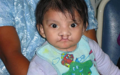 Cleft Lip Patient Stories from Guatemala 2009 Mission